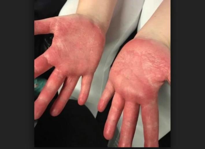 Madre quema la mano de su hijo porque pensó que le había 