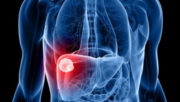 #DíaMundialdelaHepatitis: la enfermedad silenciosa de 350 millones