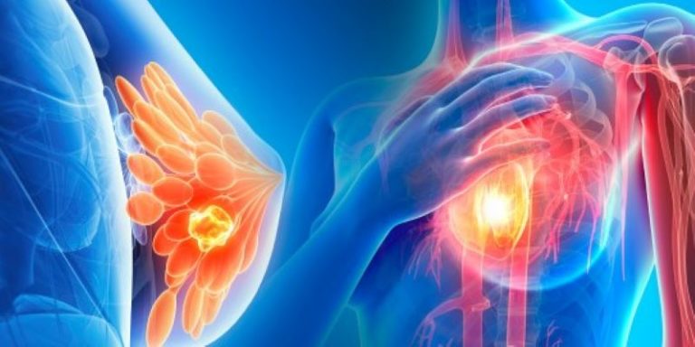 Desarrollan método para detectar cáncer de mama en 10 minutos