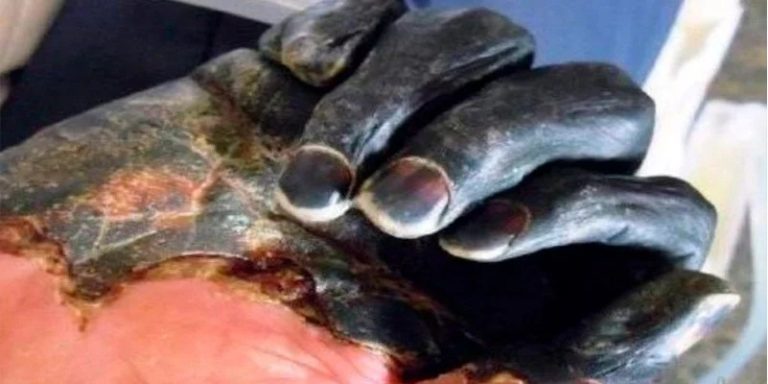 China, dos casos de peste bubónica