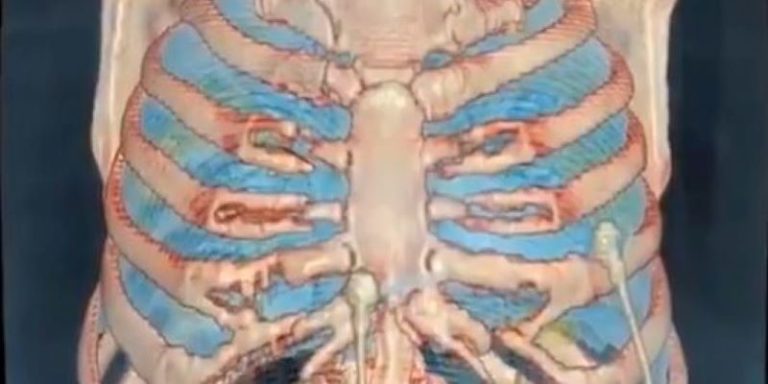 Vídeo en 3D muestra los efectos del Covid-19 en los pulmones