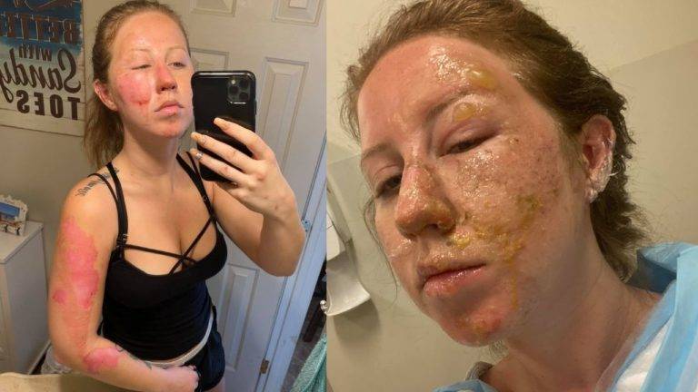 Meseros encienden bebida y queman el rostro de una turista en Quintana Roo