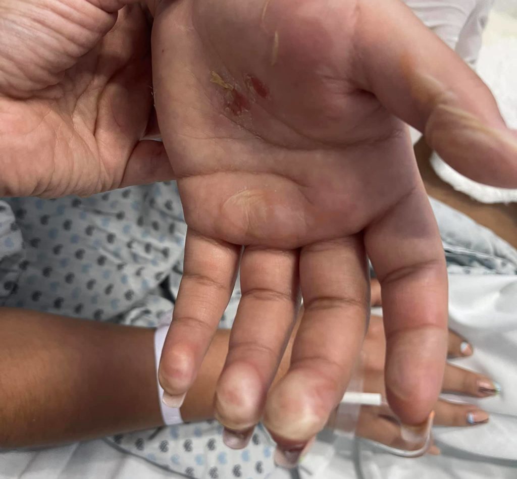 Marlene exige justicia, su hija fue atacada con ácido y responsabiliza a su exmarido