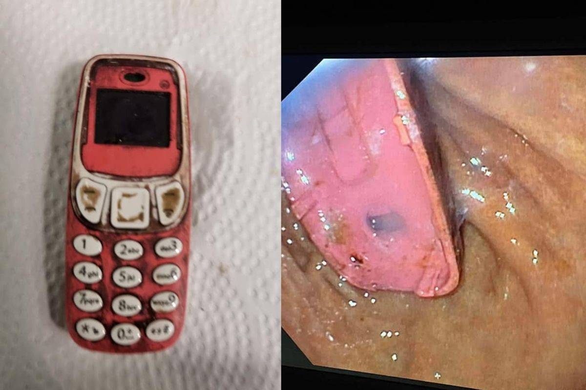 Hombre es operado de emergencia, tenia un teléfono Nokia en su estómago