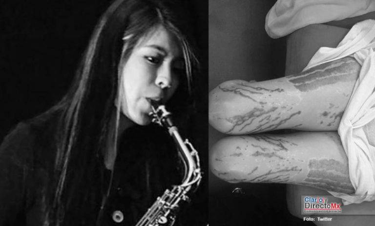 Saxofonista atacada con acido acusa a juez de ser cómplice de sus agresores