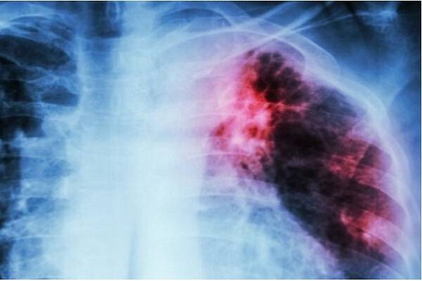 Tuberculosis se ha incrementado en el mundo: OMS