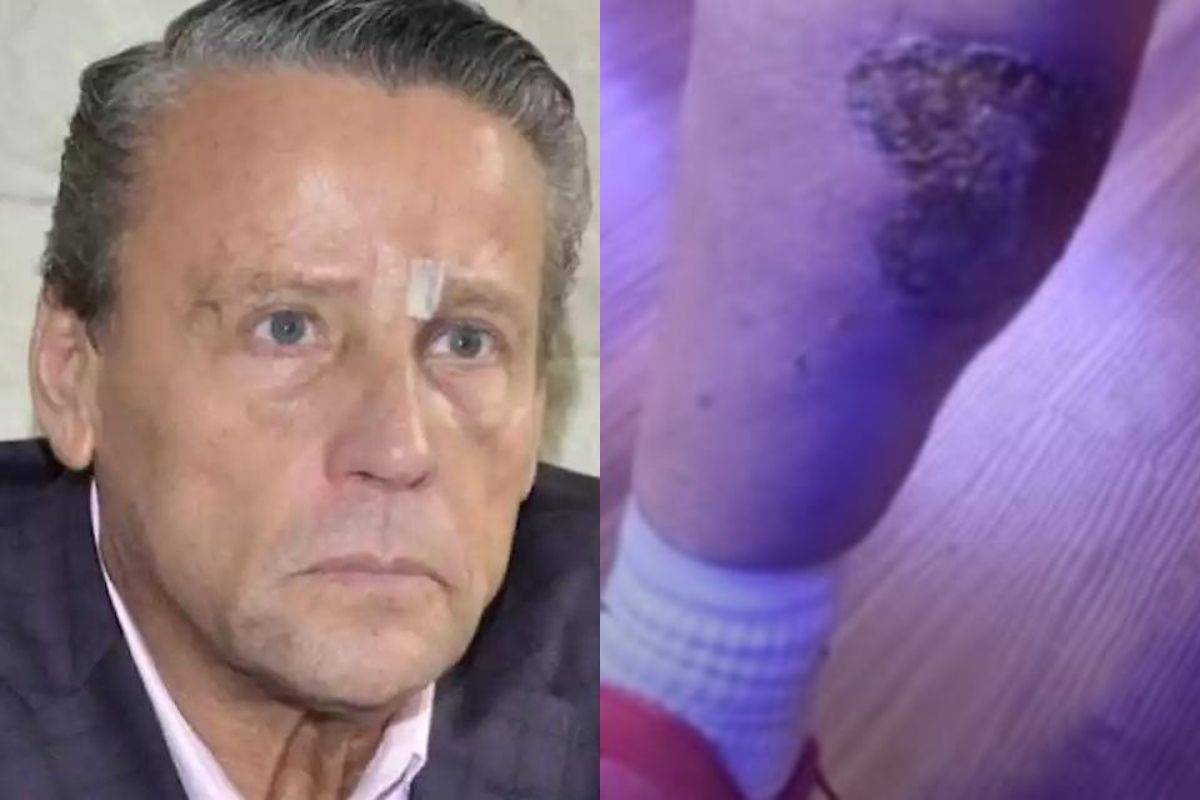 Alfredo Adame se accidentó en su moto; sufrió quemadura grave