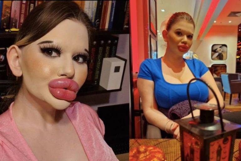 Mujer Quiere Romper Récord De Los Labios Más Grandes Del Mundo Podría Morir Regeneraciónmx